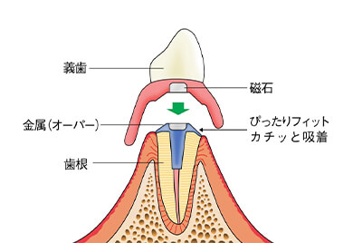 磁性アタッチメント